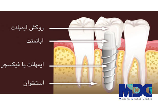ایمپلنت دندان چیست