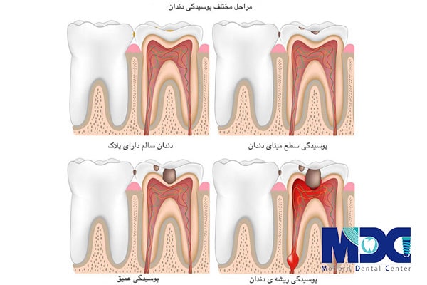 جلوگیری از پوسیدگی دندان