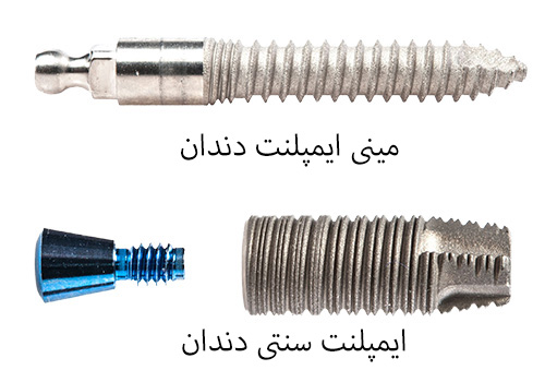 ظاهر مینی ایمپلنت دندان-کلینیک دندان پزشکی مدرن