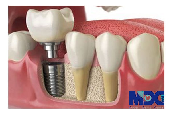 دندان مصنوعی معمولی و تفاوت آن با ایمپلنت