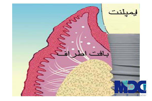 تاثیر کراتین بر بافت ایمپلنت