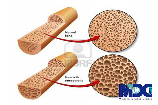 کاشت ایمپلنت در افراد با پوکی استخوان نوع 1