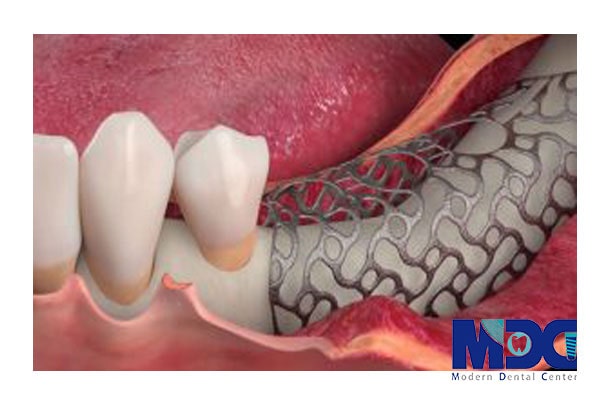 پیوند استخوان در ایمپلنت بوسیله مش تیتانیوم