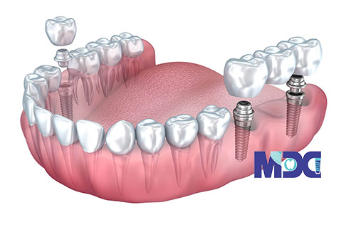 بریج دندان ایمپلنت پایه-کلینیک دندان پزشکی مدرن