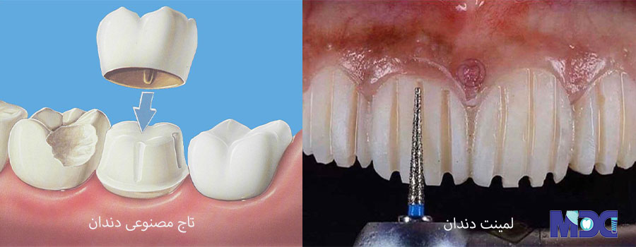 عوارض جانبی لمینت دندان